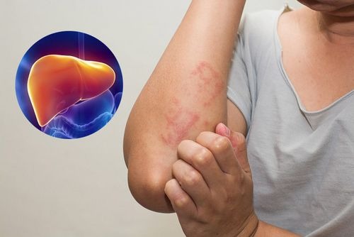 dấu hiệu men gan cao